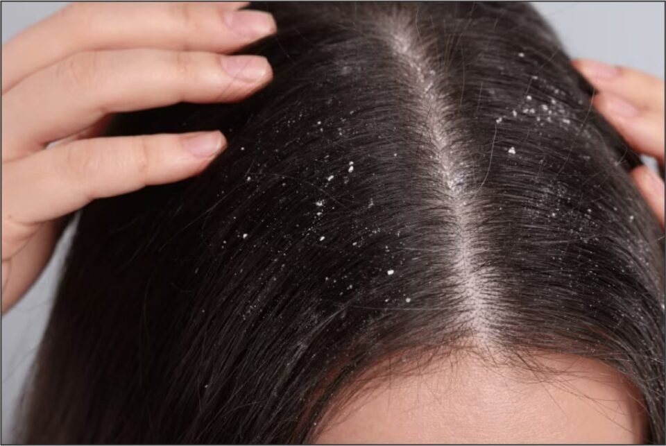 Home Remedies for Dandruff